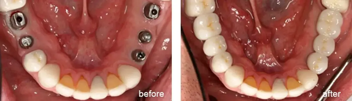 Implants to replace mandibular posterior teeth